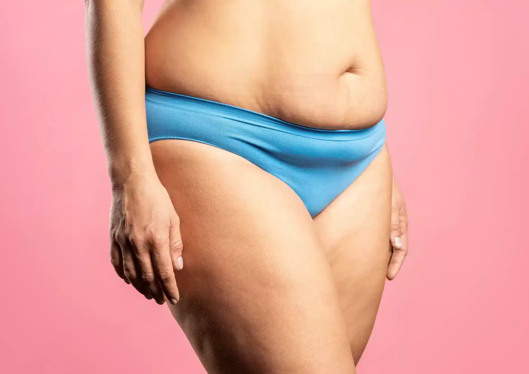 tummy tuck