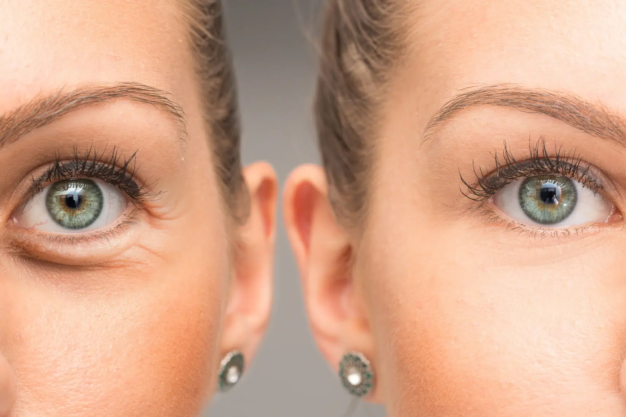 Close-up image of two women's faces side by side, focusing on their eyes and part of their noses. Both have blue eyes, eyelashes accentuated with mascara, and are wearing small stud earrings with decorative green stones. Their eyebrows are groomed beautifully, possibly complemented by Juvederm Tear Trough Treatment.