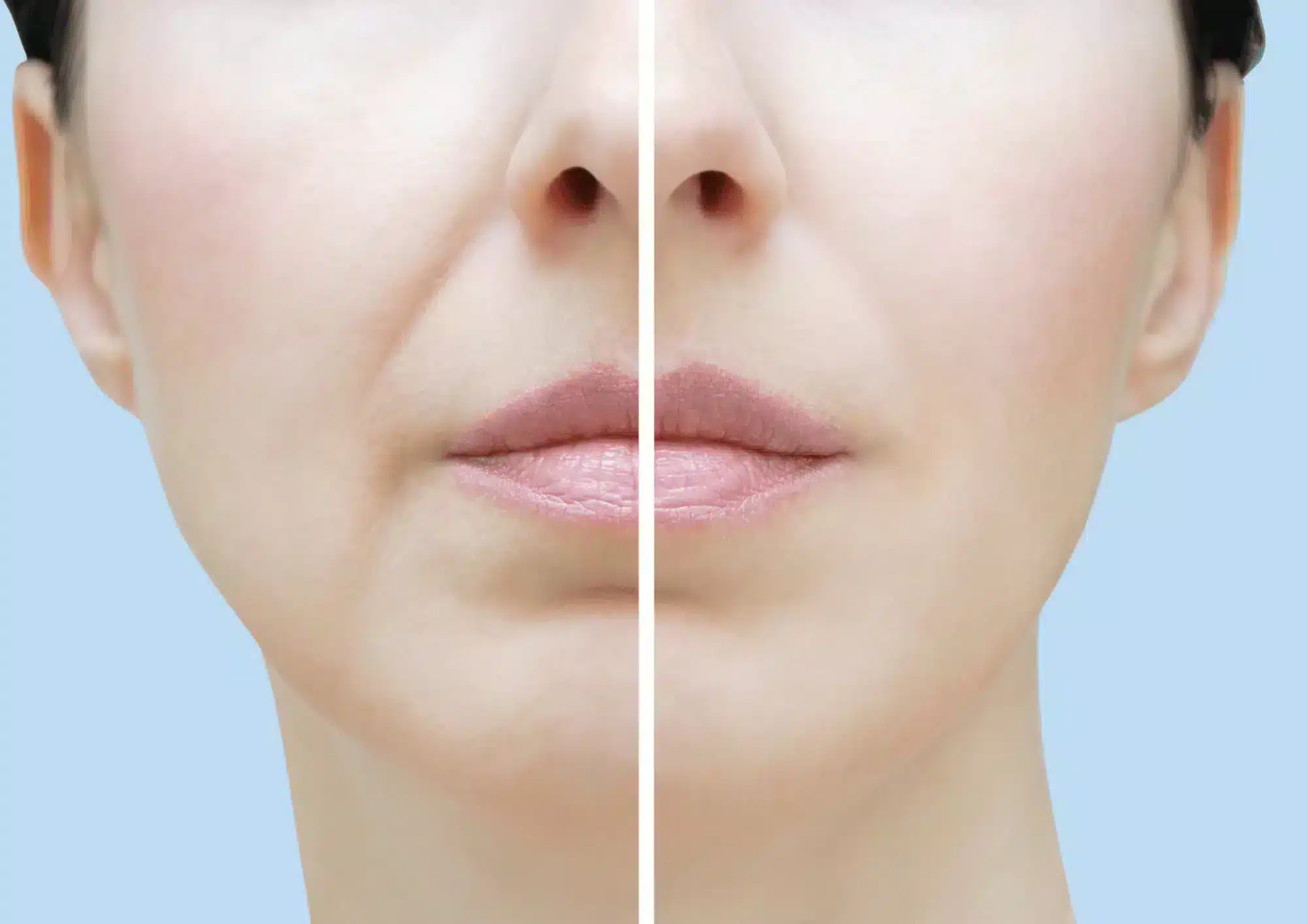 juvederm nasolabial