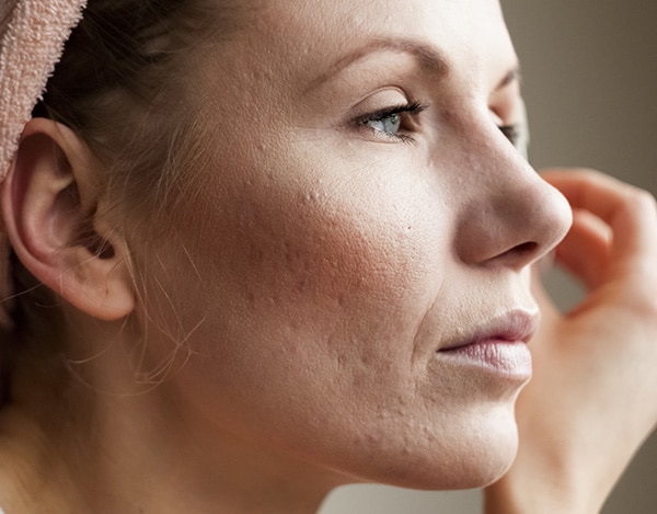 Close-up of a person's face showing visible skin texture, including fine lines and some acne scars. The individual, who might consider treating acne scarring with soft tissue fillers, is looking to the side, wearing a light pink headband and appears to be in natural lighting.