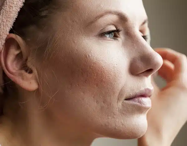 Close-up of a person's face showing visible skin texture, including fine lines and some acne scars. The individual, who might consider treating acne scarring with soft tissue fillers, is looking to the side, wearing a light pink headband and appears to be in natural lighting.
