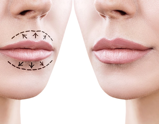 Close-up of a woman's lips showing a comparison before and after Lips for Successful Rejuvenation. A dotted line with arrows points to the lips on the left side, while the right side displays fuller, smoother results without any markings.