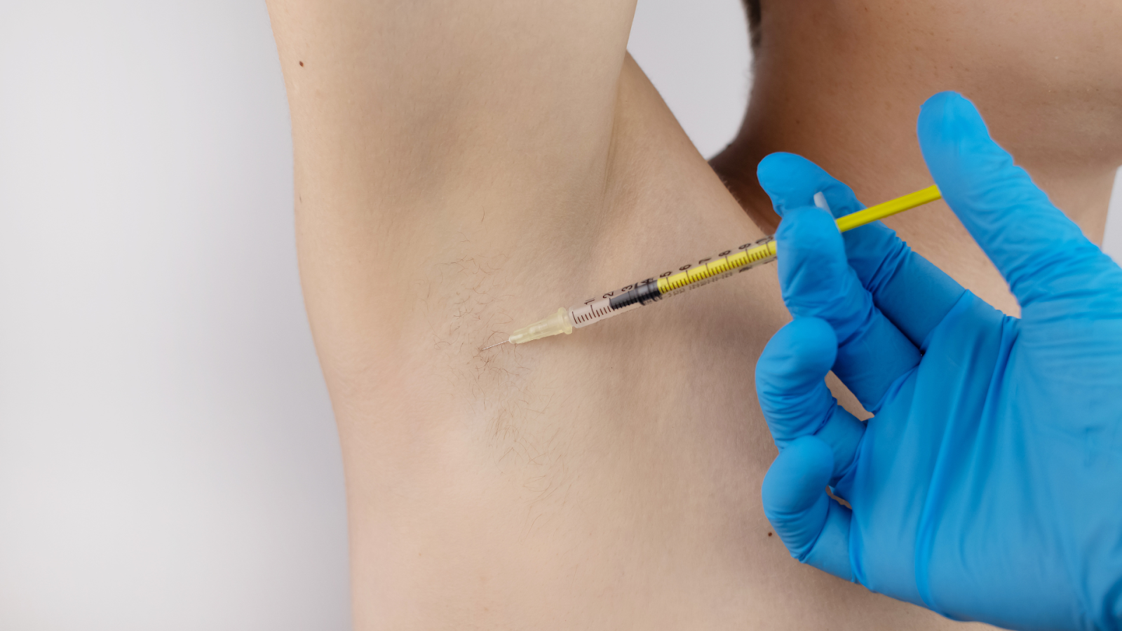 An individual getting a Botox injection for their underarms.