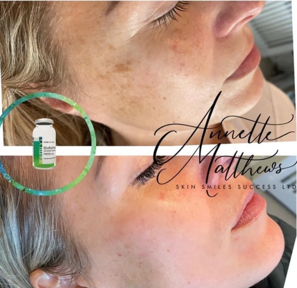 A UK clinic conducted a Biorepeel case study and presented a patient's before and after photos.