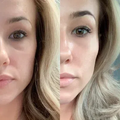 A patient's before and after photos of her Juvederm contour treatment.
