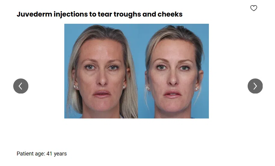 A patient received Juvederm injections to treat tear troughs and cheeks.