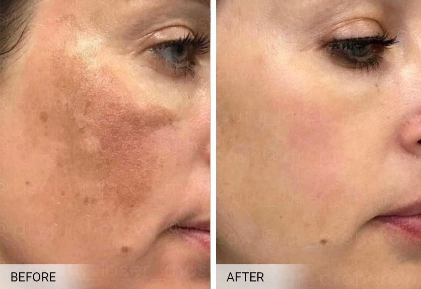 A patient undergoes a Biorepeel chemical peel to treat melasma on their skin.