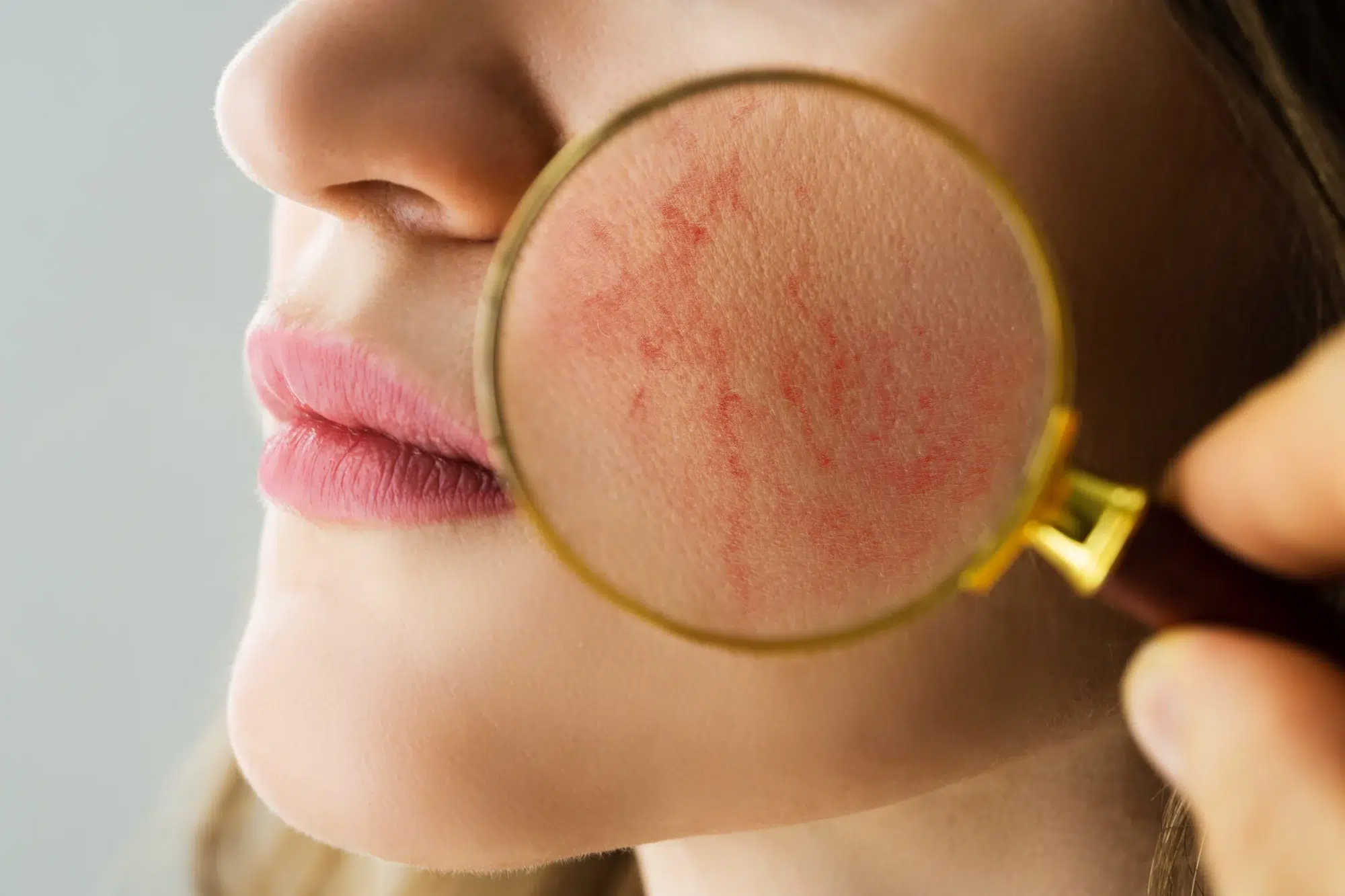 zoom on female patient's face with rosacea