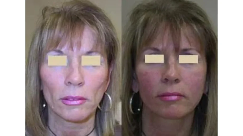 A before-and-after photo of a patient who received Radiesse on their cheek region.