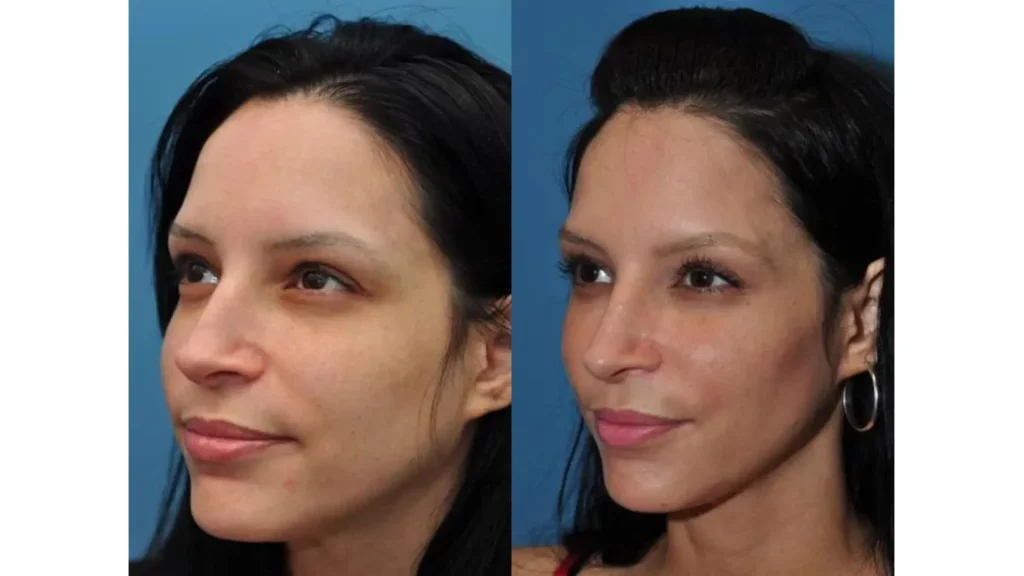 An individual getting a more prominent cheekbones after their Radiesse for cheeks treatment.