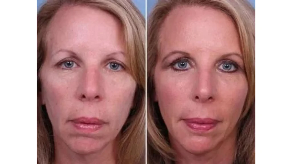 A patient's before and after photo showing their cheeks' firmer and fuller look after Radiesse injections.