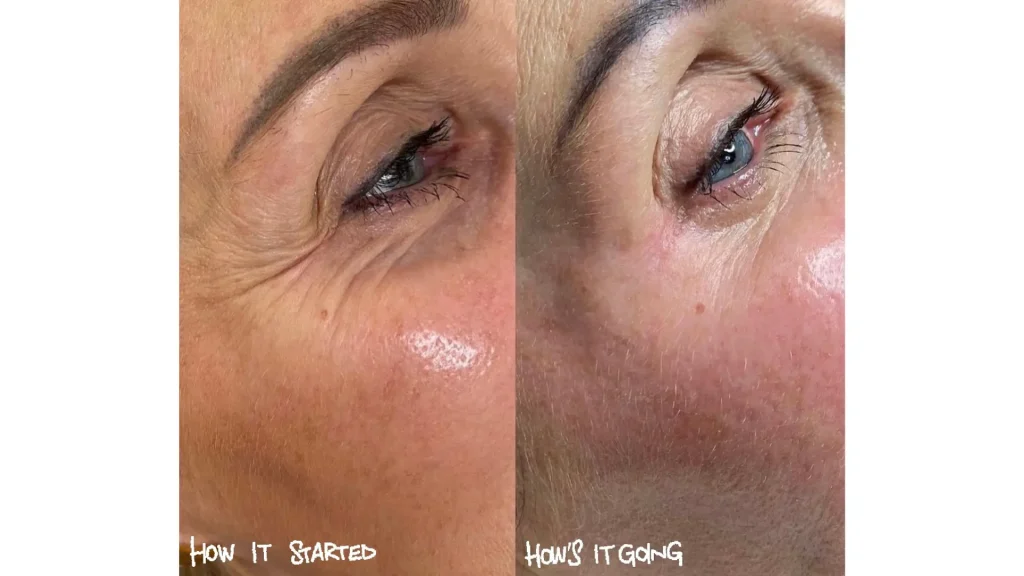 A patient's before and after photos addressing fine lines in their eye area with Jalupro Young Eye injections.