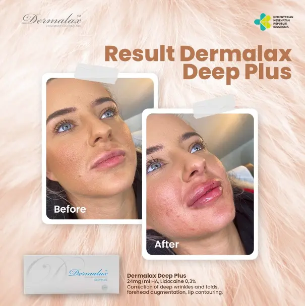 A patient's before and after photo of their Dermalax Deep Plus lip filler injection.