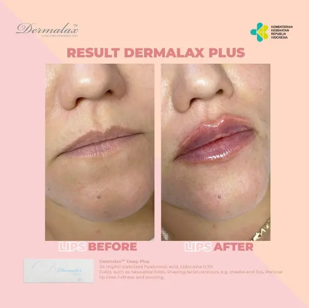 A patient achieved fuller lips with Dermalax Deep Plus injections.