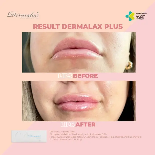 A patient received symmetrical lips after their Dermalax lip filler treatment.