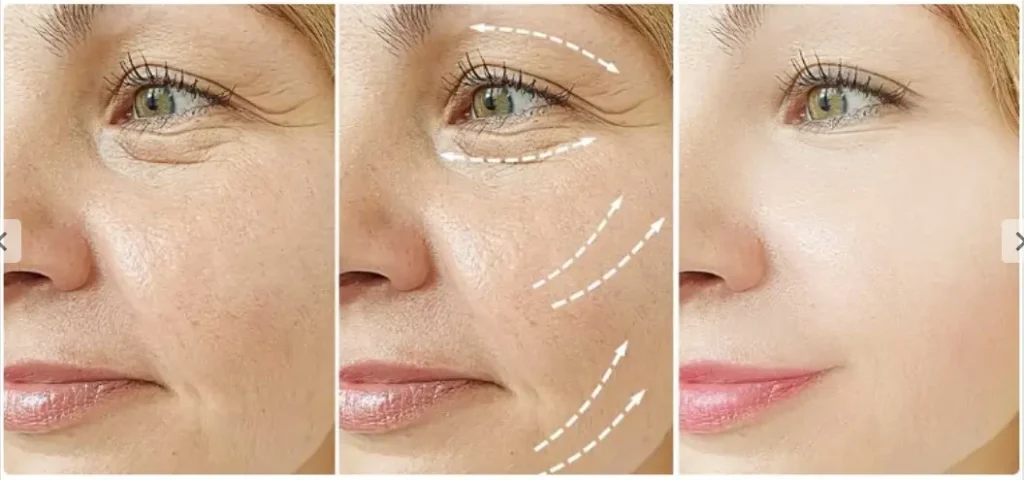 A patient's before and photos of their Jalupro Super Hydro injectable procedure for their cheek and undereyes region.