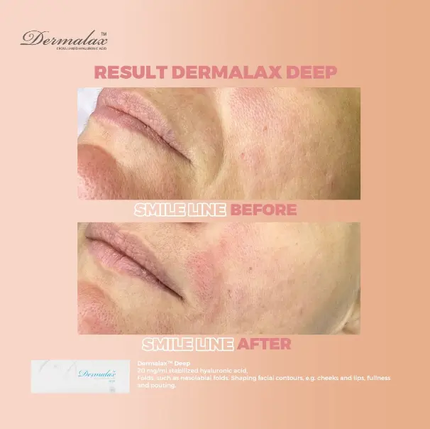 A patient's before and after photos of their Dermalax Deep-treated smile lines.