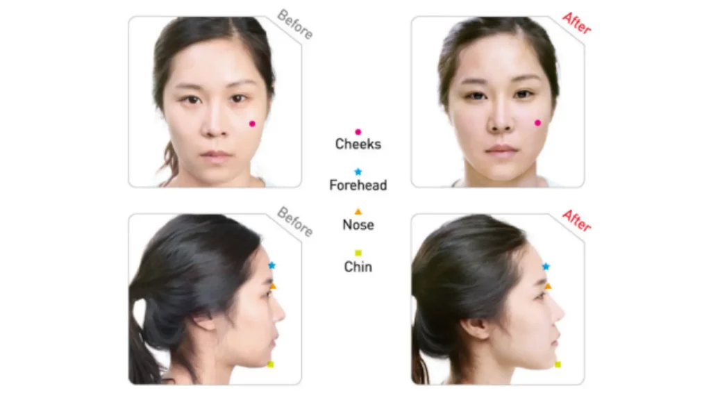 This patient received an overall facial augmentation with Dermalax Deep Plus which showed impressive results.