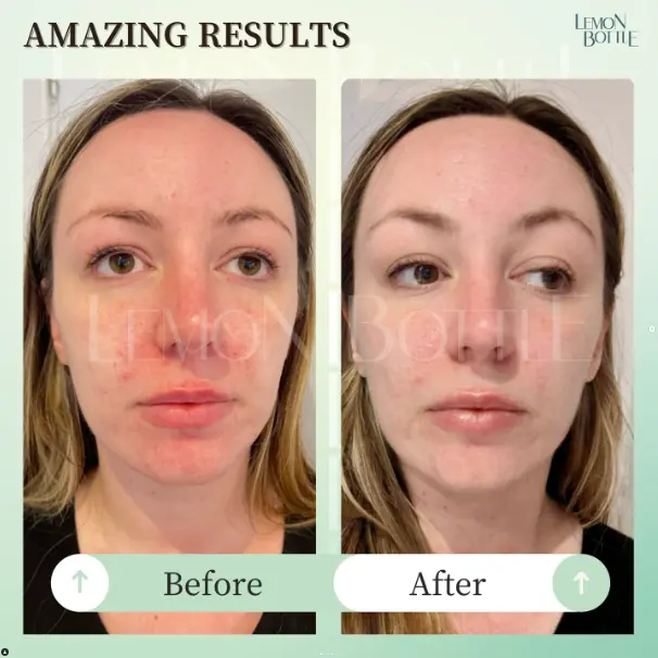 A patient's before and after photo of their Lemon Bottle Skin Booster treatment.