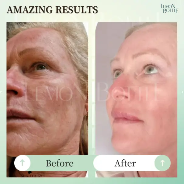 An older individual shows off their before and after Lemon Bottle Skin Booster treatment.