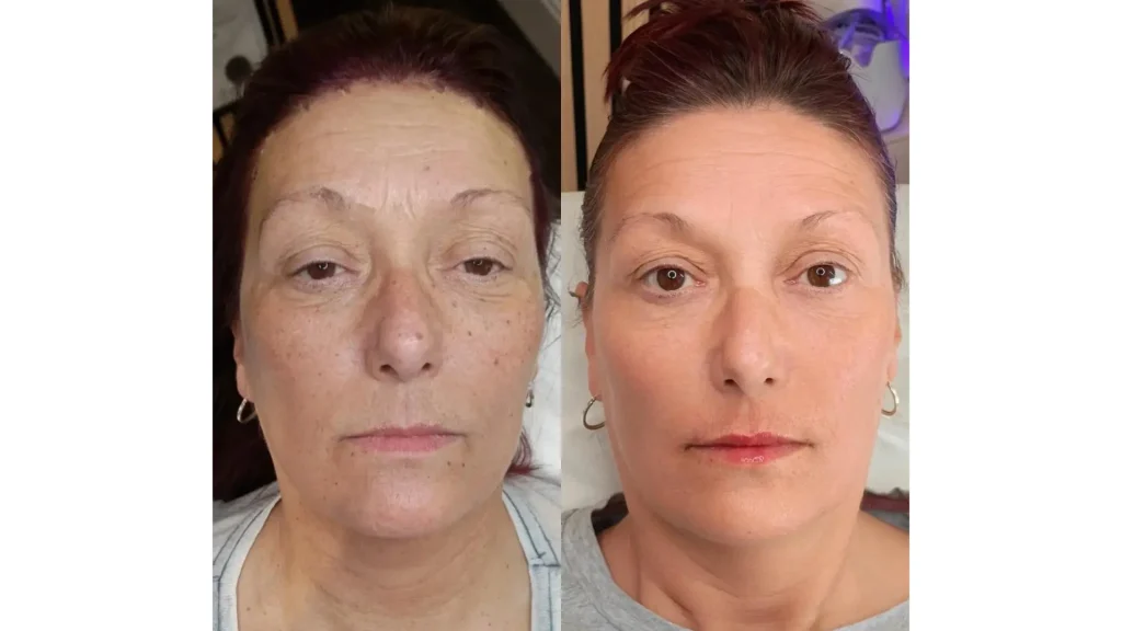 Jalupro injections delivering this patient's facial skin rejuvenation after treatment.