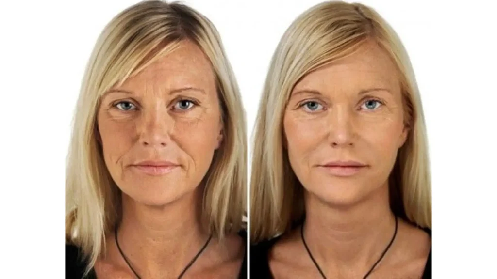 A patient's Jalupro before and after photos of their rejuvenated skin after treatment.