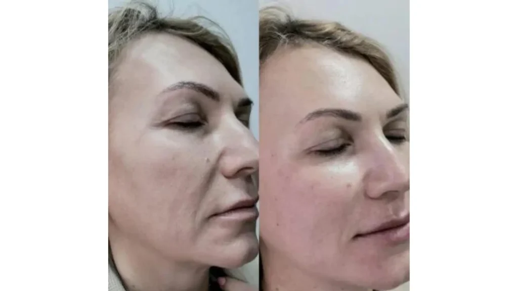 A patient's before and after photos of their Jalupro injections on their mid-face region.