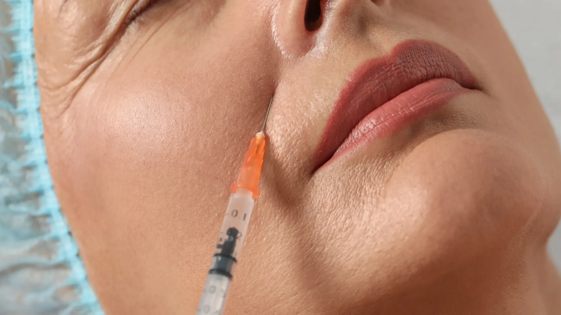 An individual receiving injections for their nasolabial folds.