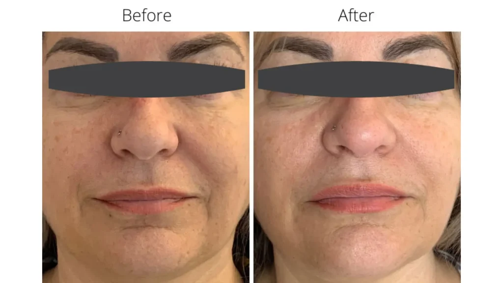 A patient received Jalupro injections for their facial skin to treat nasolabial folds and other aging signs.