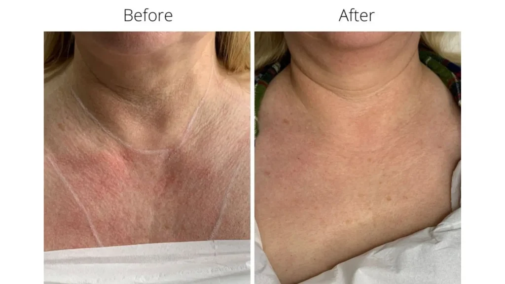 A patient's before and after photos of their chest area after their Jalupro injection.