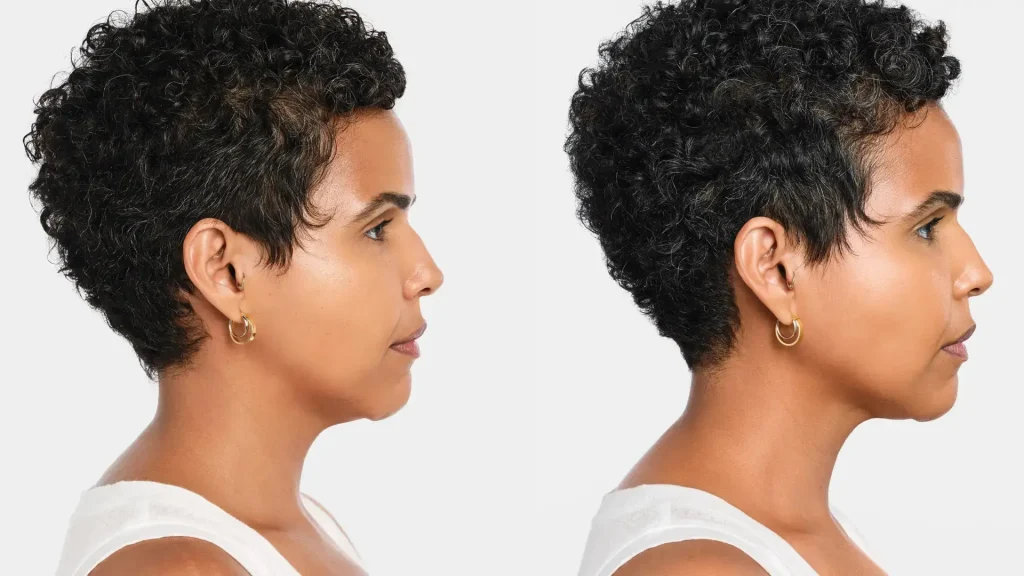 A female patients showcase their jawline's significant improvement after their Radiesse contour treatment.