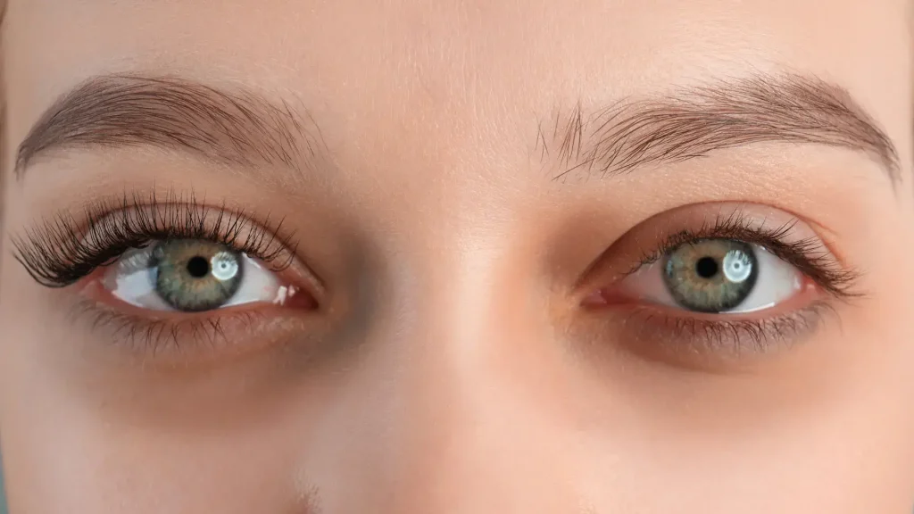 An individual struggling with dark circles and eyebags.