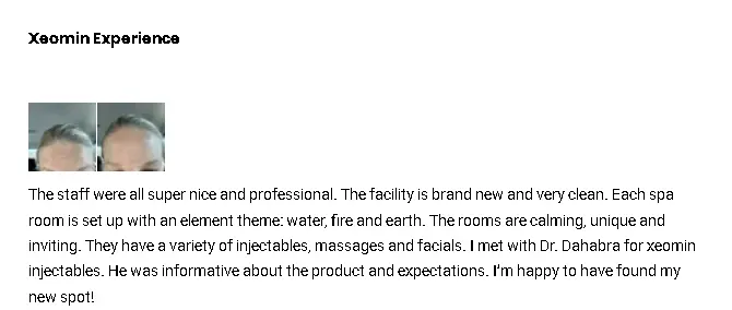 A Xeomin-treated patient's review on their positive experience with the injectable.