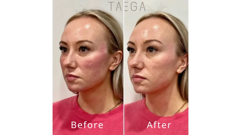 A patient's before and after photos of their Rejuran Healer treatment.