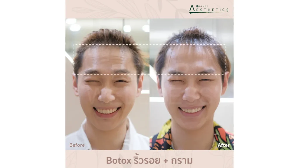 A patient's Nabota before and after experience on their forehead lines.