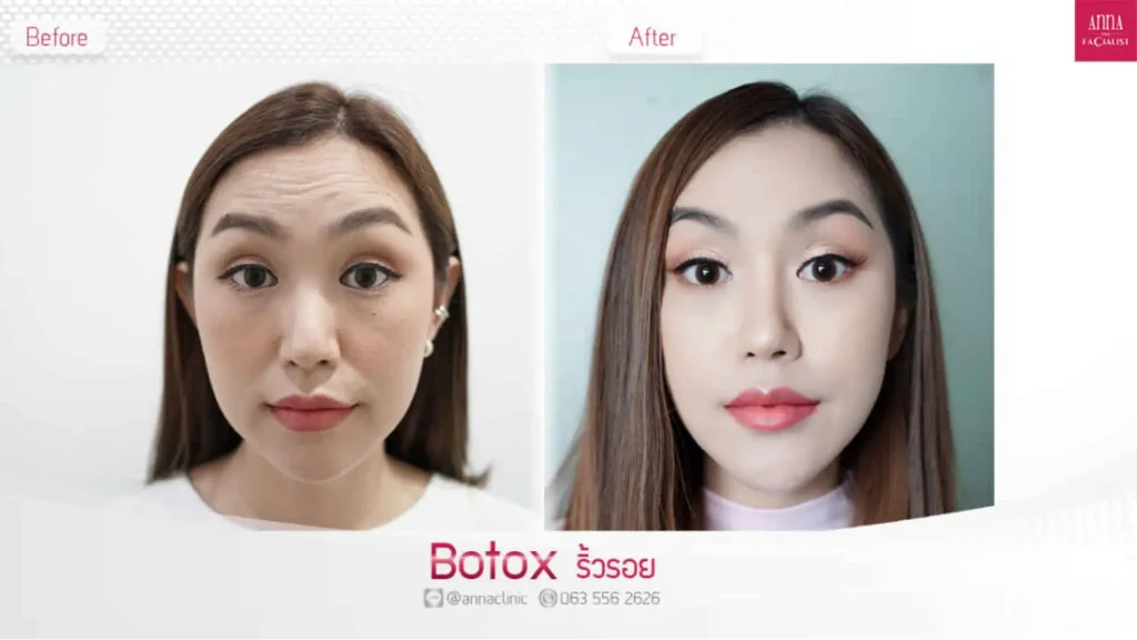 A Nabota-treated patient's before and after photo of their forehead lines.