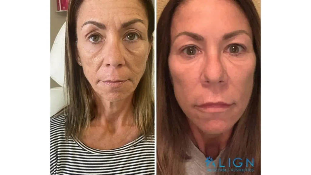 A patient improved their facial wrinkles and lines after their Xeomin injection.