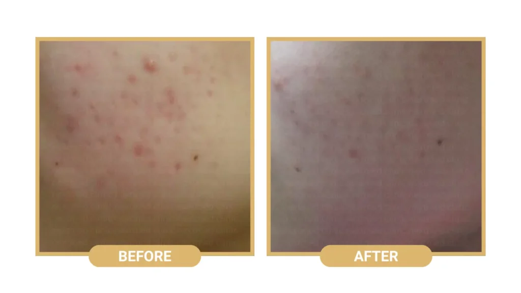 A patient's Rejuran before and after photos showcasing the improvement in their cheeks and acne.