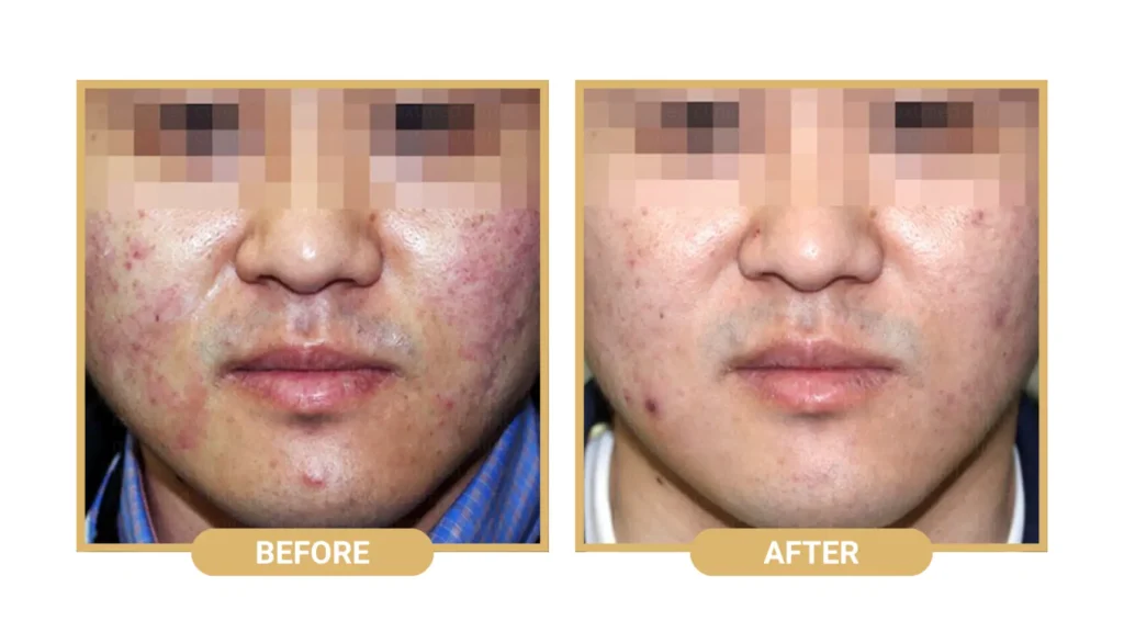 An individual received Rejuran Healer treatment and achieved better skin texture and appearance.