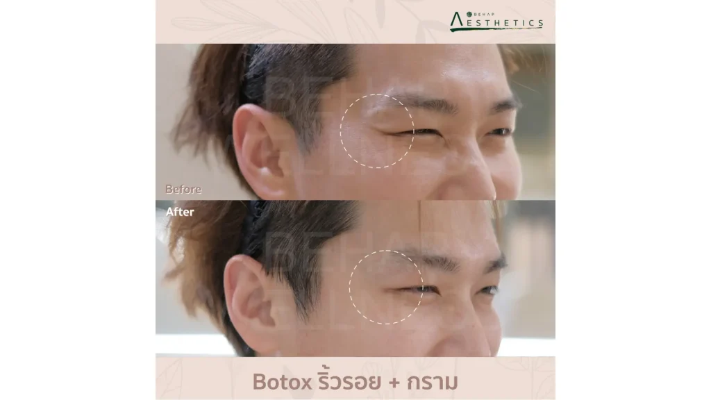 A patient's before and after photo on their Nabota treatment.