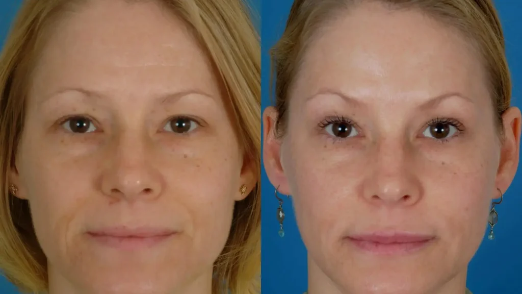 A Botox-treated patient's before and after photo of their wrinkle and lines reduction treatment.