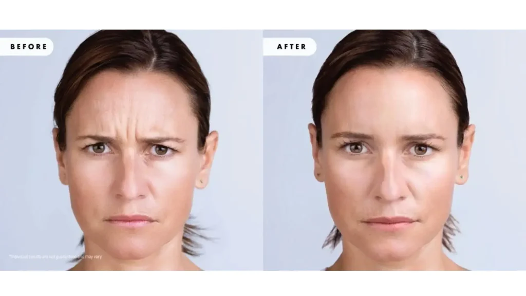 A patient showing their natural-looking enhancement on their forehead lines with Xeomin.