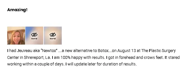 A Jeuveau-treated patient's review on their positive experience with the neuromodulator.