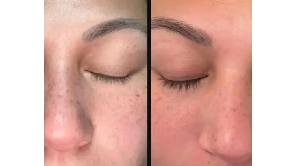 A patient's before and after photo of their Latisse treatment.