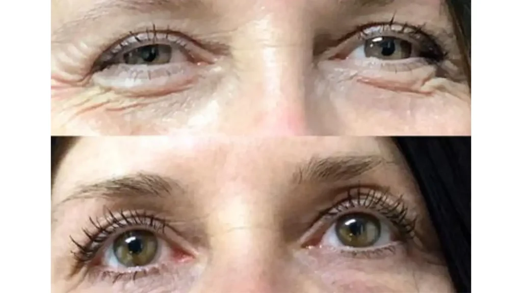A Latisse before and after photo of their experience with the bimatoprost solution.