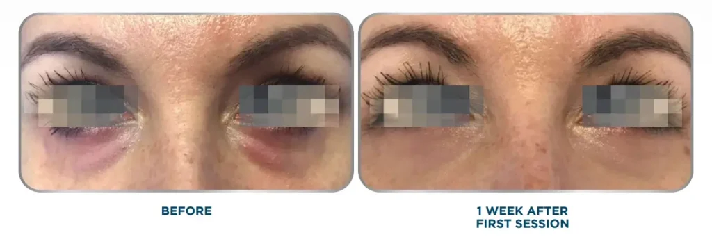 A patient's before and after photo of their Sunekos tear trough treatment.