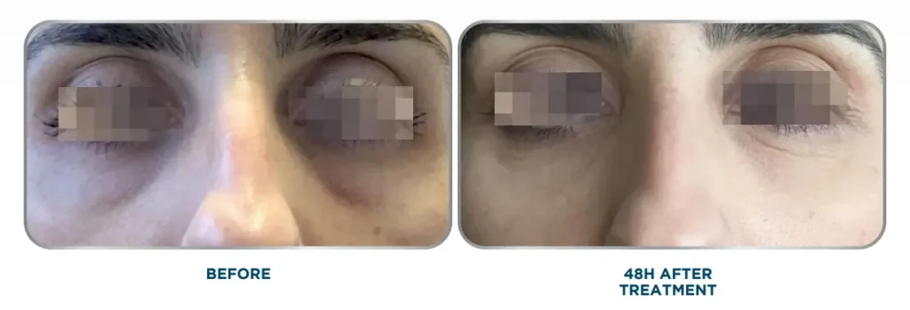 An individual receiving an injection for their under eye aging signs.