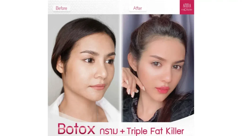 An individual undergoing a combination treatment with Nabota and a fat reduction solution.