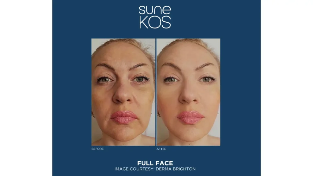 An individual's Sunekos before and after photo of their improved skin texture.