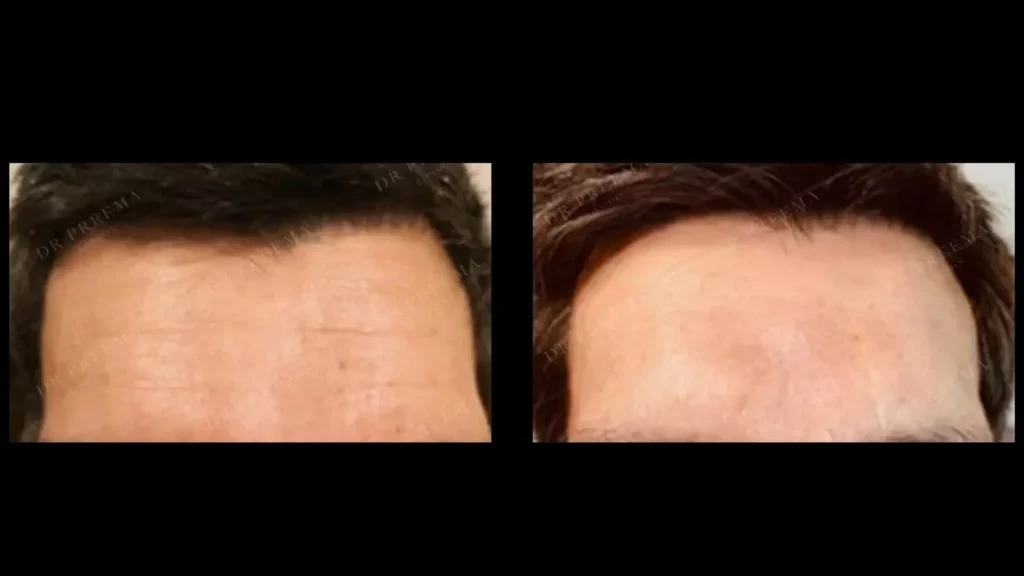 An individual's before and after photo of their Profhilo treatment on their forehead.
